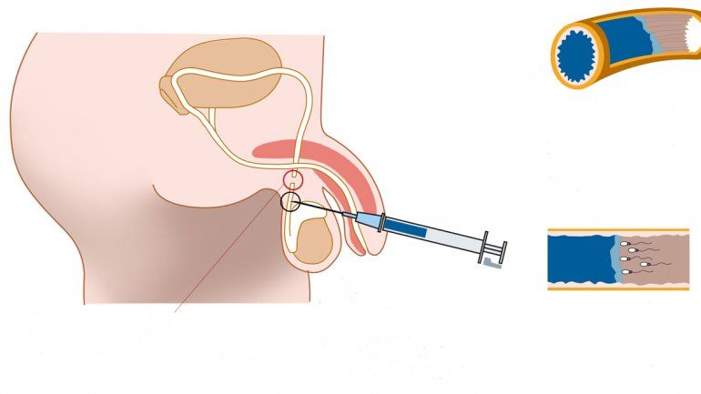 Como se hace la vasectomia reversible