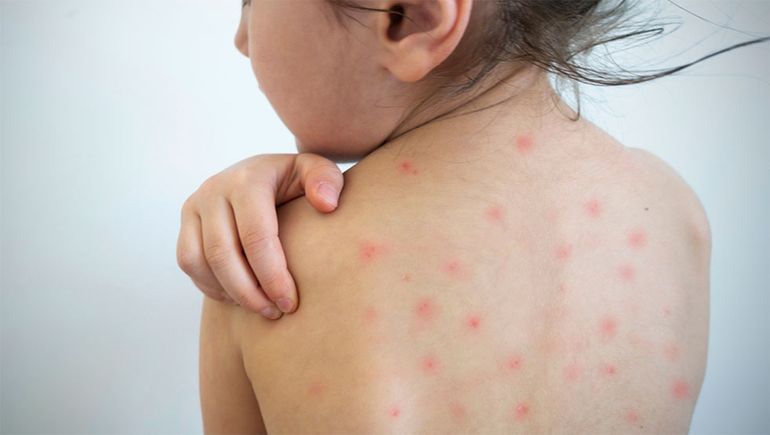Las provincias argentinas resolvieron reforzar la vacunación para prevenir el Sarampión, Río Negro no cuenta con casos activos.