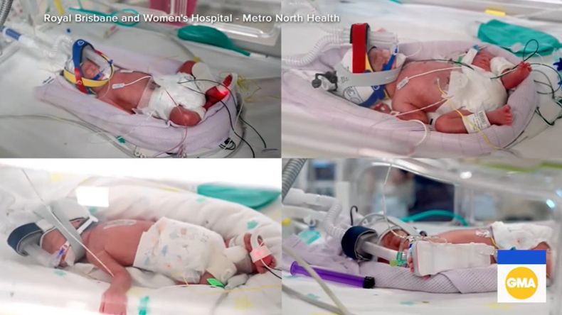 El nacimiento múltiple tuvo lugar en un hospital del estado de Queensland, en Australia. | LMCipolletti.com El nacimiento múltiple tuvo lugar en un hospital del estado de Queensland, en Australia.