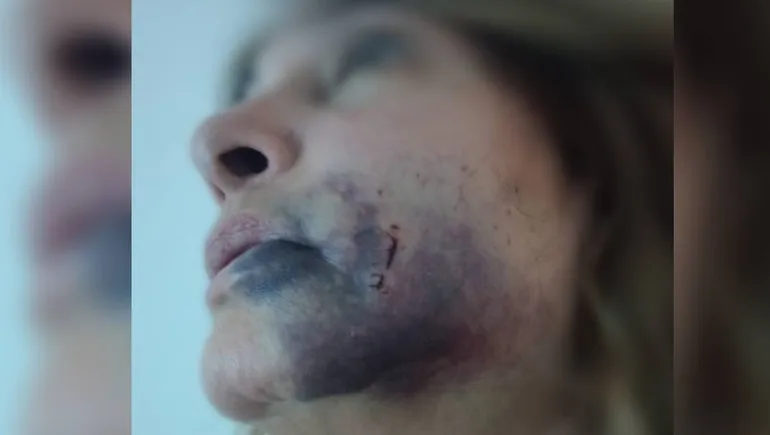 Así quedó la inspectora que fue agredida en la plaza del Arroba.