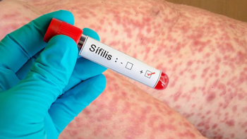 sifilis: menos cuidado y mas casos, la opinion de un experto sifilis: menos cuidado y mas casos, la opinion de un experto