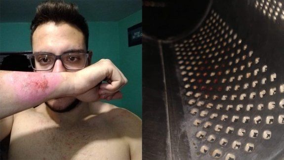 La historia del joven que se borró un tatuaje con un rallador de queso