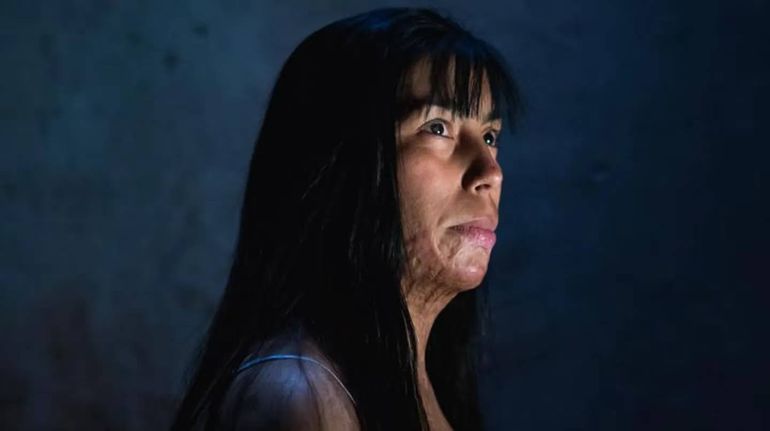 Su novio la prendió fuego, la operaron 69 veces y ahora lucha por conseguir justicia