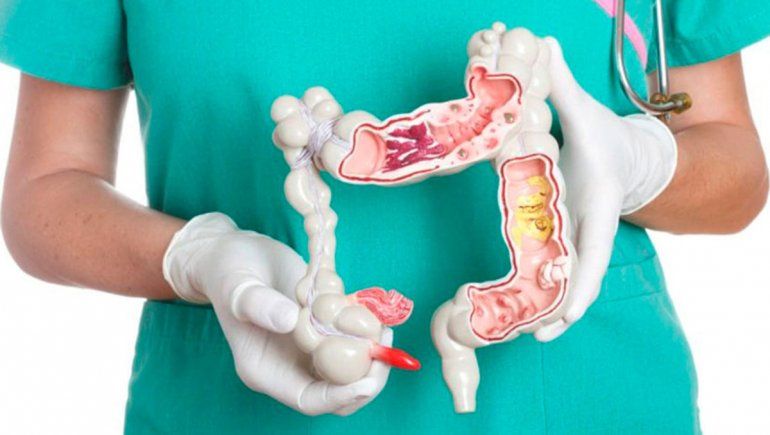 Preocupa el incremento de casos de cáncer de colon a edades más tempranas.