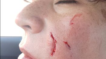 Luego del ataque, la víctima mostró las heridas que sufrió: el perro se escapó de un patio por un alambrado roto y fue directo hacia ella. 