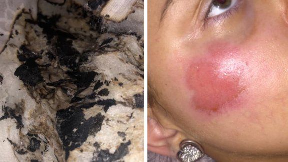 Explotó cargador de iPhone y le quemó la cara mientras dormía