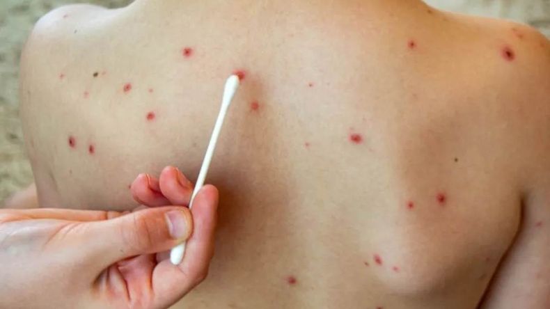 Tras los últimos casos de sarampión detectados en la Argentina, el Ministerio de Salud emitió una alerta sanitaria y recomendó controlarse y vacunarse. | LMCipolletti.com Tras los últimos casos de sarampión detectados en la Argentina, el Ministerio de Salud emitió una alerta sanitaria y recomendó controlarse y vacunarse.