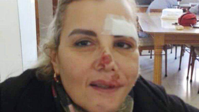 Sandra mostró en Facebook las heridas provocadas por los delincuentes.