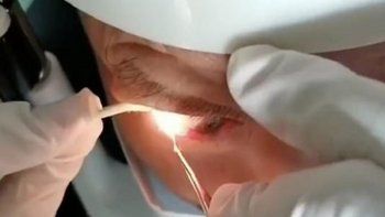 a un chino le sacaron 20 gusanos vivos de un ojo