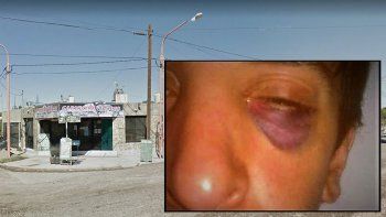 el joven de oro atacado brutalmente por motochorros fue operado del ojo y salio bien