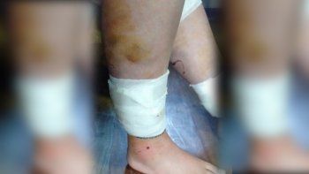 salio en bici, la atacaron diez perros y tuvo que ser operada