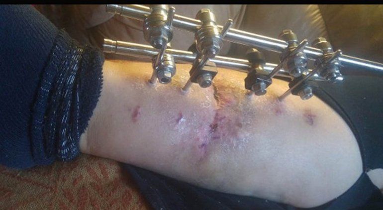 Así quedó la pierna luego de una de las cirugías.  