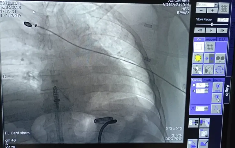 El marcapasos se colocó en un paciente de 56 años que presentaba infecciones. 