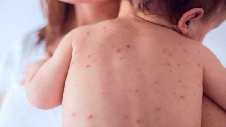 En Salud extreman cuidados para evitar casos de sarampión
