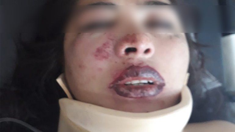 La desfiguraron la cara a la salida de un boliche en Bariloche