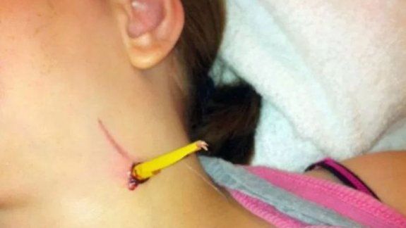Una nena se cayó en la escuela y se clavó un lápiz en el cuello 