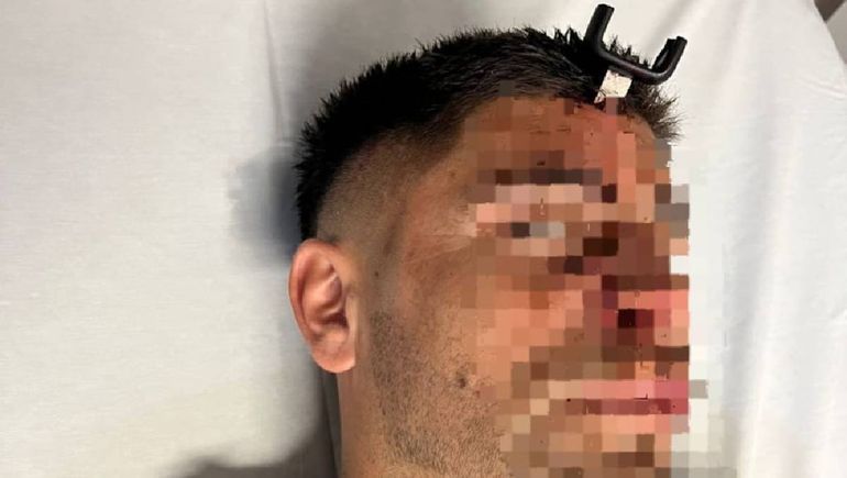 Le clavaron una llave de auto en la cabeza a un jugador del ascenso durante un partido de fútbol femenino