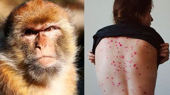 alerta mundial: viruela del mono se expande en varios paises