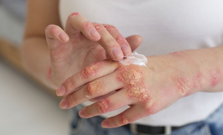 Cuando la enfermedad avanza sin diagnóstico ni tratamiento, el virus de la sífilis puede mutar a una etapa secundaria con síntomas de lesiones en las palmas de manos.