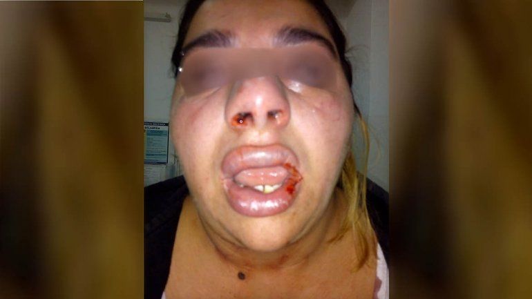 Una joven de Cinco Saltos denunció que su ex pareja la desfiguró a golpes