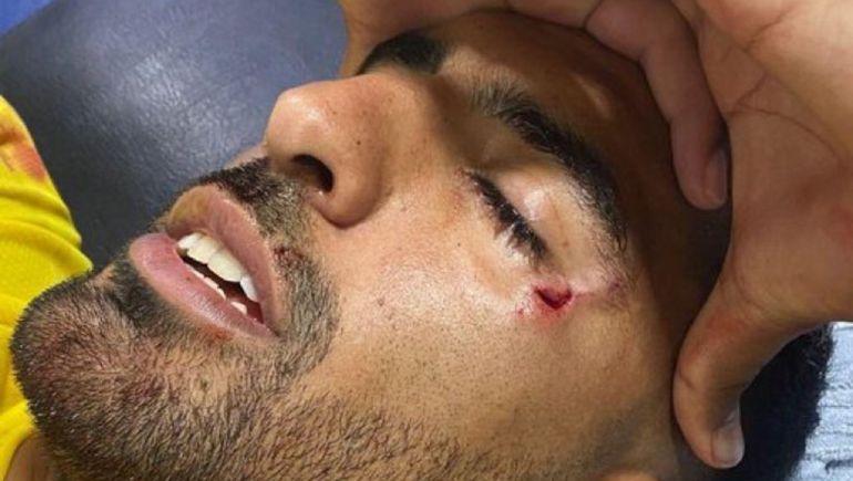 El futbolista uruguayo Maximiliano Olivera recibió un piedrazo al final del partido. En el vestuario se descompensó y debió ser llevado al hospital de urgencia.