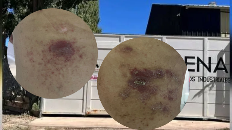 Las partículas de polvo y pintura le agravó el cuadro de dermatitis a una vecina de Parque Industrial. 