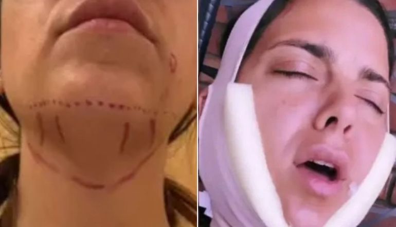 Belu Lucius decidió hacerse una operación en la cara.