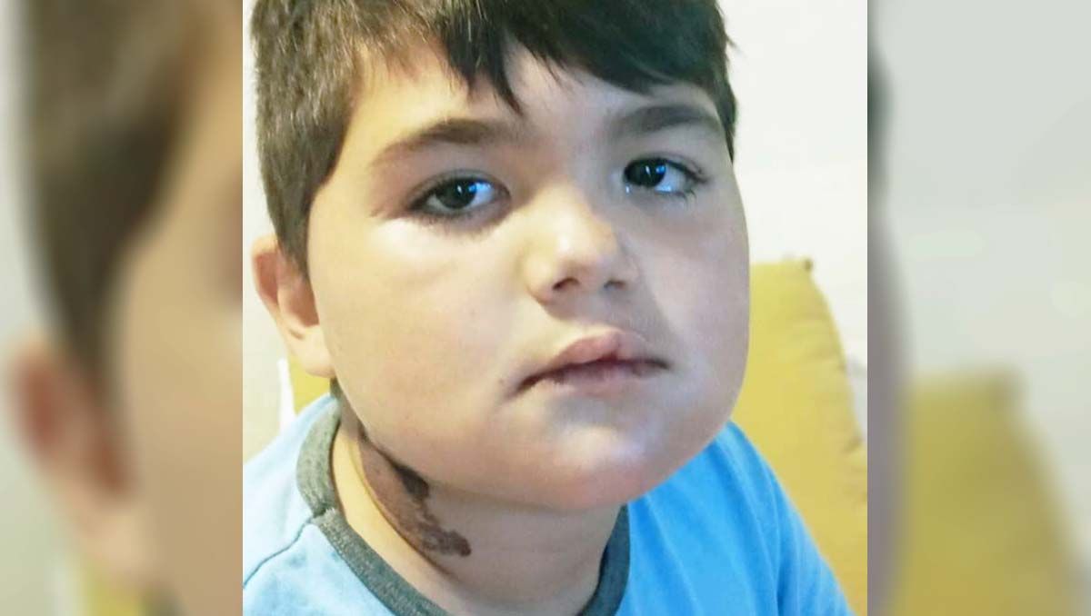 Cómo está el nene que se le cayó una parrilla en la cara