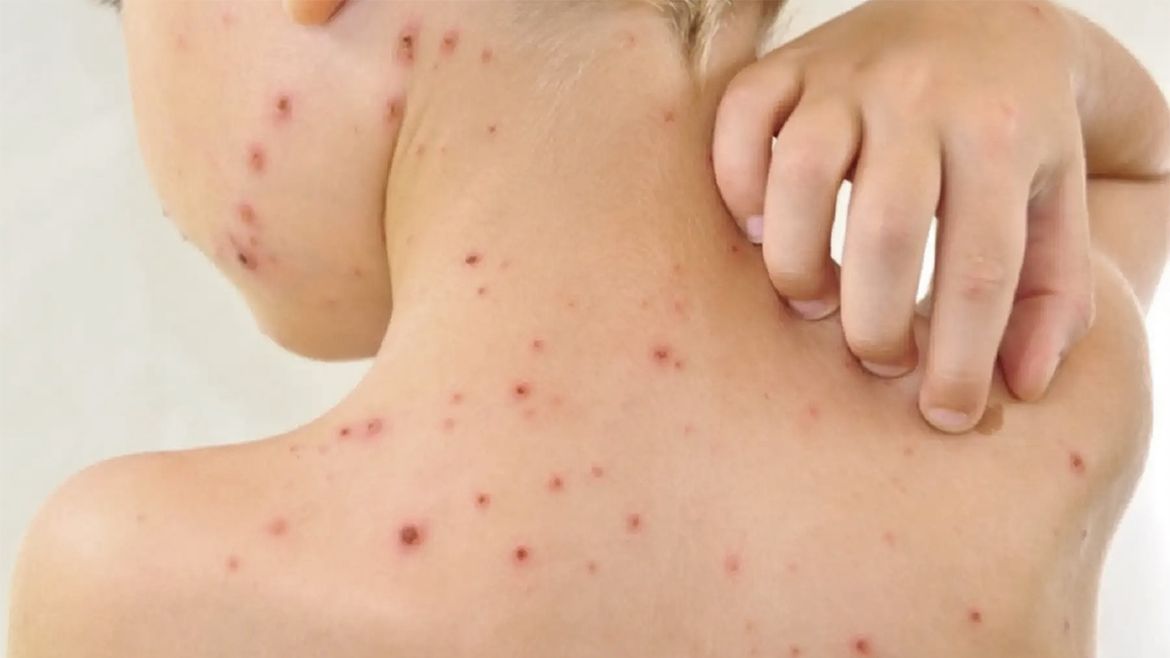 El brote de varicela que se registró en las últimas horas en Fernández Oro, obligó al sistema de salud de Cipolletti a emitir recomendaciones. | LMCipolletti.com El brote de varicela que se registró en las últimas horas en Fernández Oro, obligó al sistema de salud de Cipolletti a emitir recomendaciones.