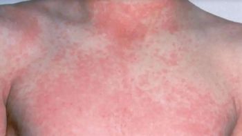 ¿que es la escarlatina o fiebre escarlata?