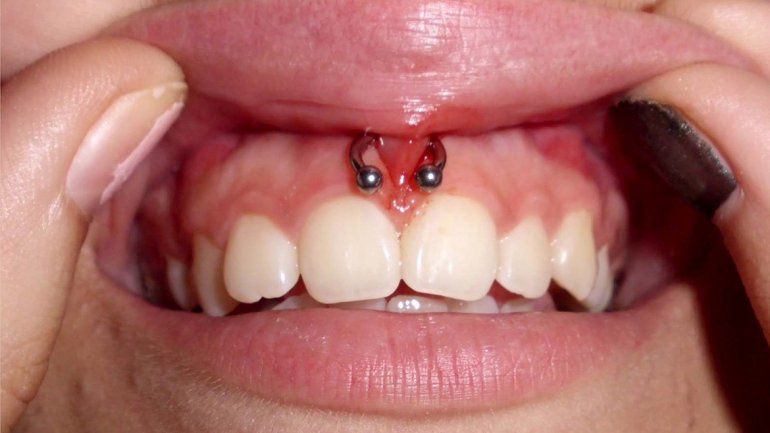 Las lesiones generadas por los piercings en la boca