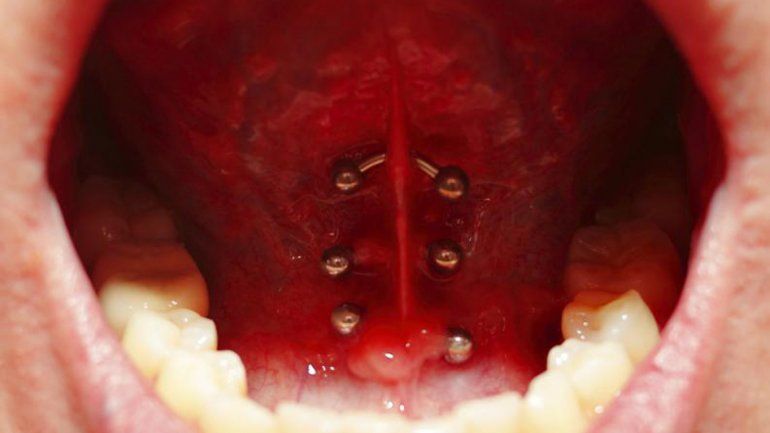 Las lesiones generadas por los piercings en la boca