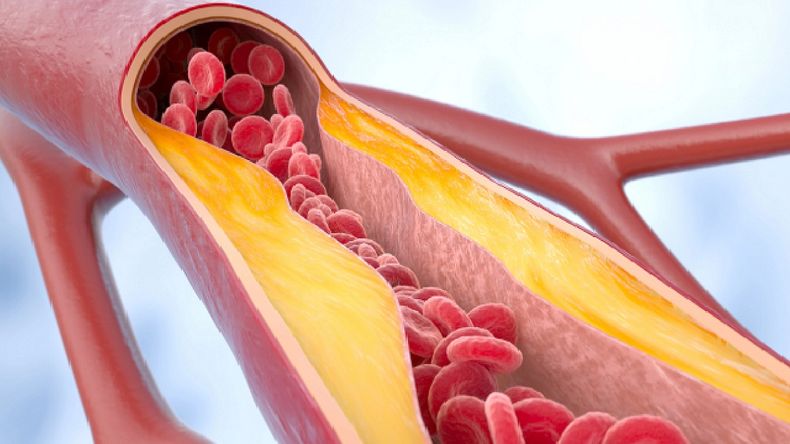 Los accidentes cerebrovasculares (ACV) e infartos son las principales causas de muerte en el mundo.