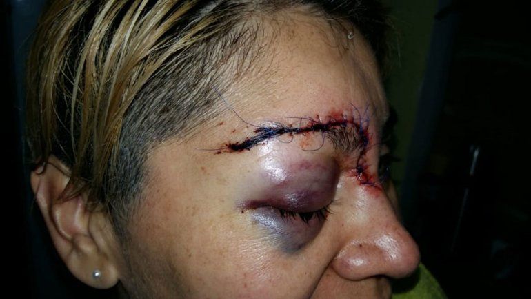 Atacó a golpes a su mamá y desfiguró a una sargento en Centenario