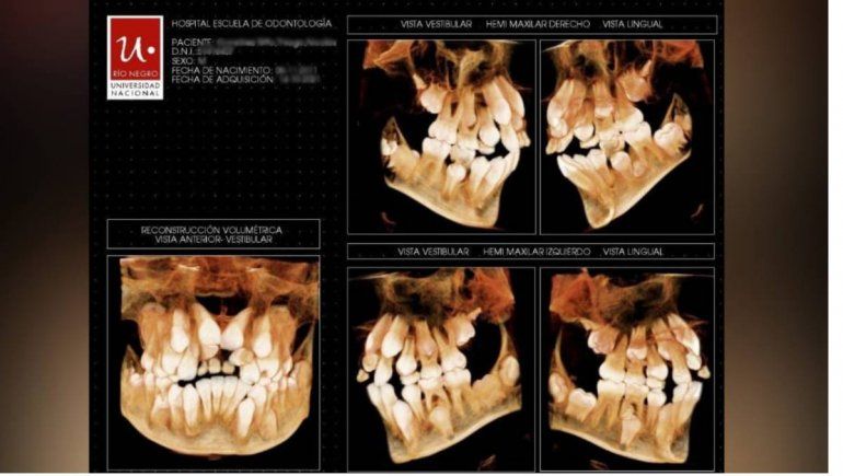 El drama de un nene que tiene ocho dientes de más y dos quistes