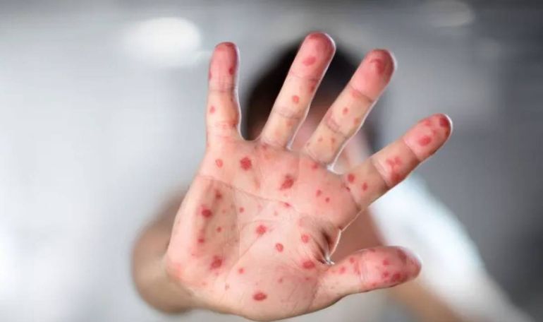 La viruela del mono llegó a la región. De los cinco casos confirmados en el país en lo que va de 2024