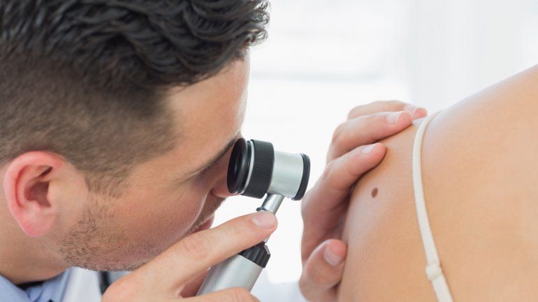 Las manchas y lunares pueden ser síntoma de cáncer de piel.