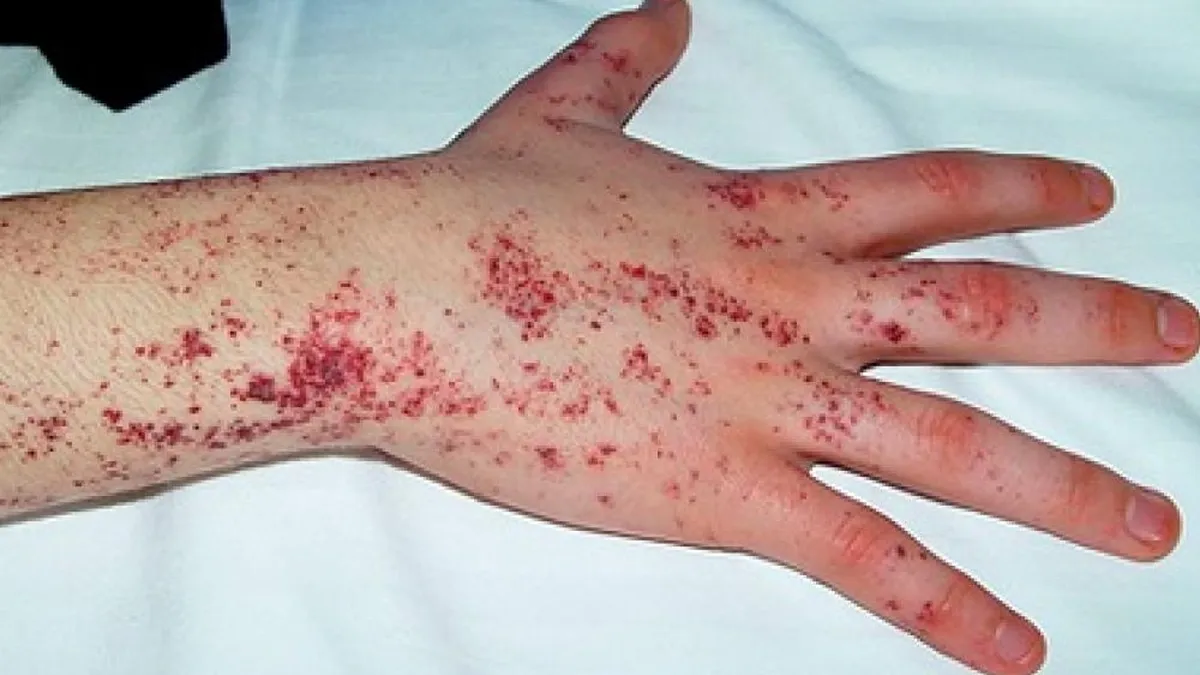 Un raro trastorno que afecta órganos vitales: qué es la Enfermedad de Fabry
