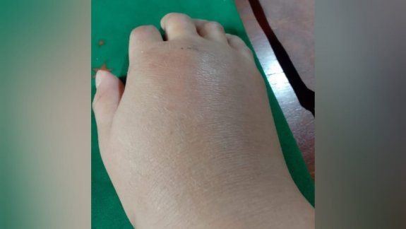 Así le dejó la mano el violento.&nbsp;