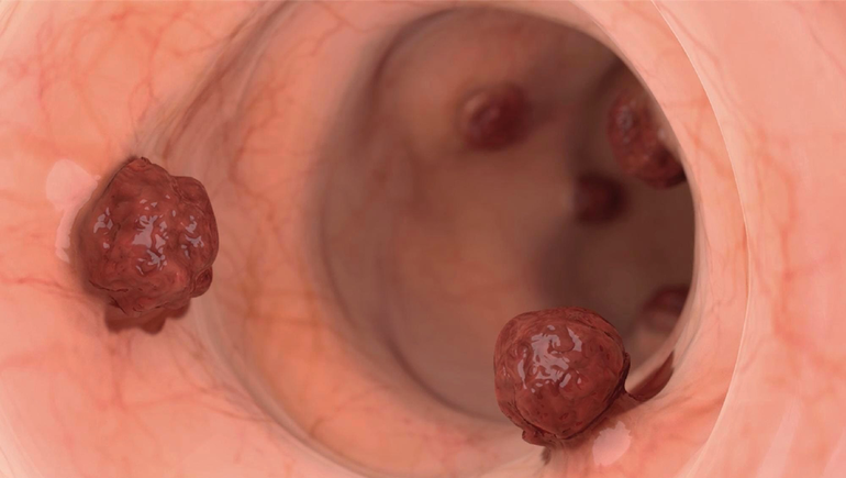 Cáncer de colon: inédito hallazgo sobre las células