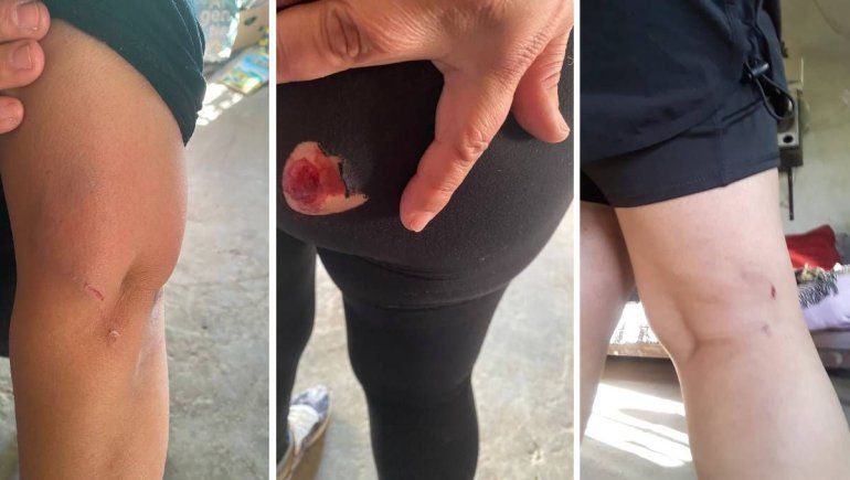 La peor lesión la sufrió en la zona de los glúteos.&nbsp;