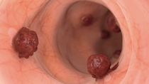 cancer de colon: inedito hallazgo sobre las celulas