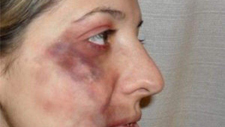 La cara desfigurada de la joven viedmense tras el ataque en el Don Bosco.
