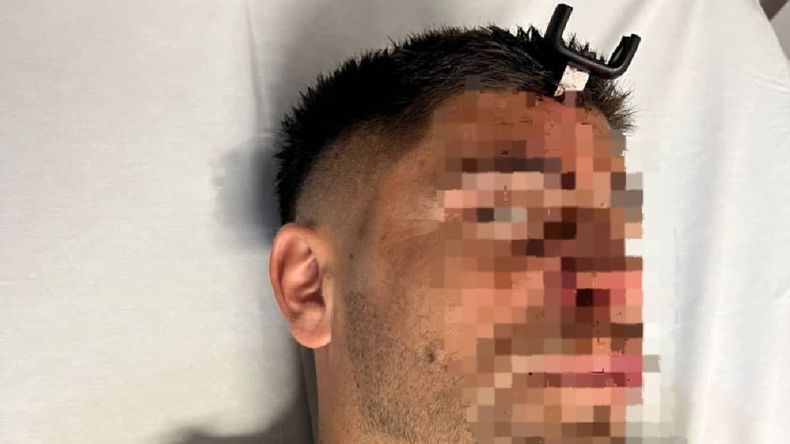 Le clavaron una llave de auto en la cabeza a un jugador del ascenso durante un partido de fútbol femenino | LMCipolletti.com Le clavaron una llave de auto en la cabeza a un jugador del ascenso durante un partido de fútbol femenino