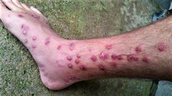 alerta por el aumento de ataques de piojo de pato en los lagos 