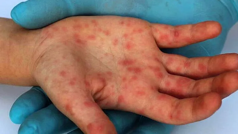 El primer caso de viruela del mono registrado en 2024 en Río Negro corresponde a un joven de Cipolletti, que presenta un cuadro clínico leve.