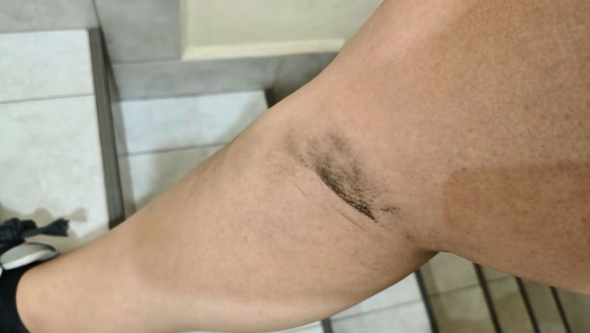 La marca que le quedó a la vecina que denunció que un agente de tránsito municipal la atacó a piñas y patadas.&nbsp;