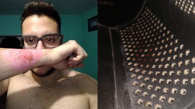 Conocé la historia del joven que se borró un tatuaje con un rallador de queso