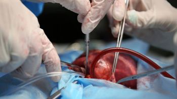 cuantos pacientes hay en lista de espera por un trasplante renal en rio negro cuantos pacientes hay en lista de espera por un trasplante renal en rio negro