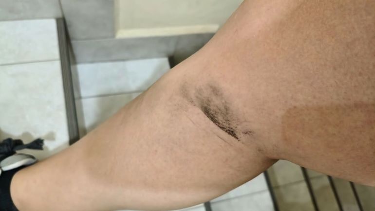 La marca que le quedó a la vecina que denunció que un agente de tránsito municipal la atacó a piñas y patadas. 